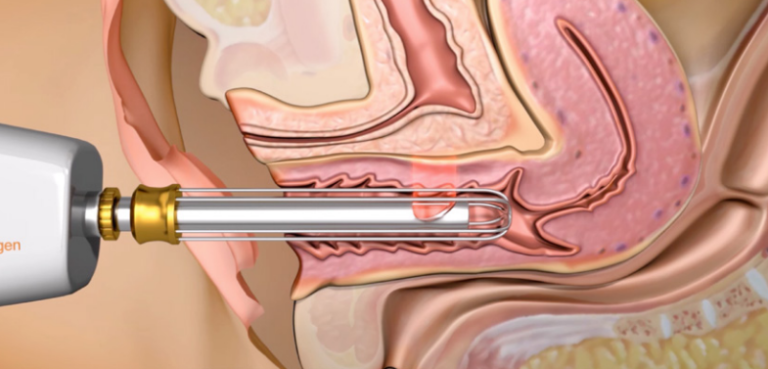 Laser íntimo antes e depois: o que os resultados realmente mostram?